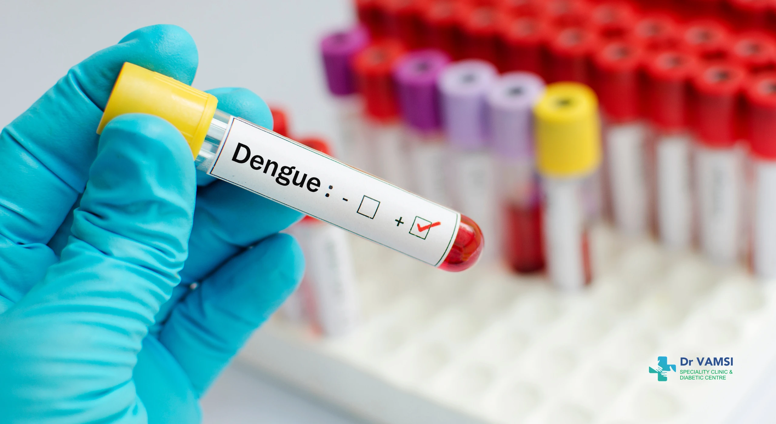 dengue symptoms in Bangalore