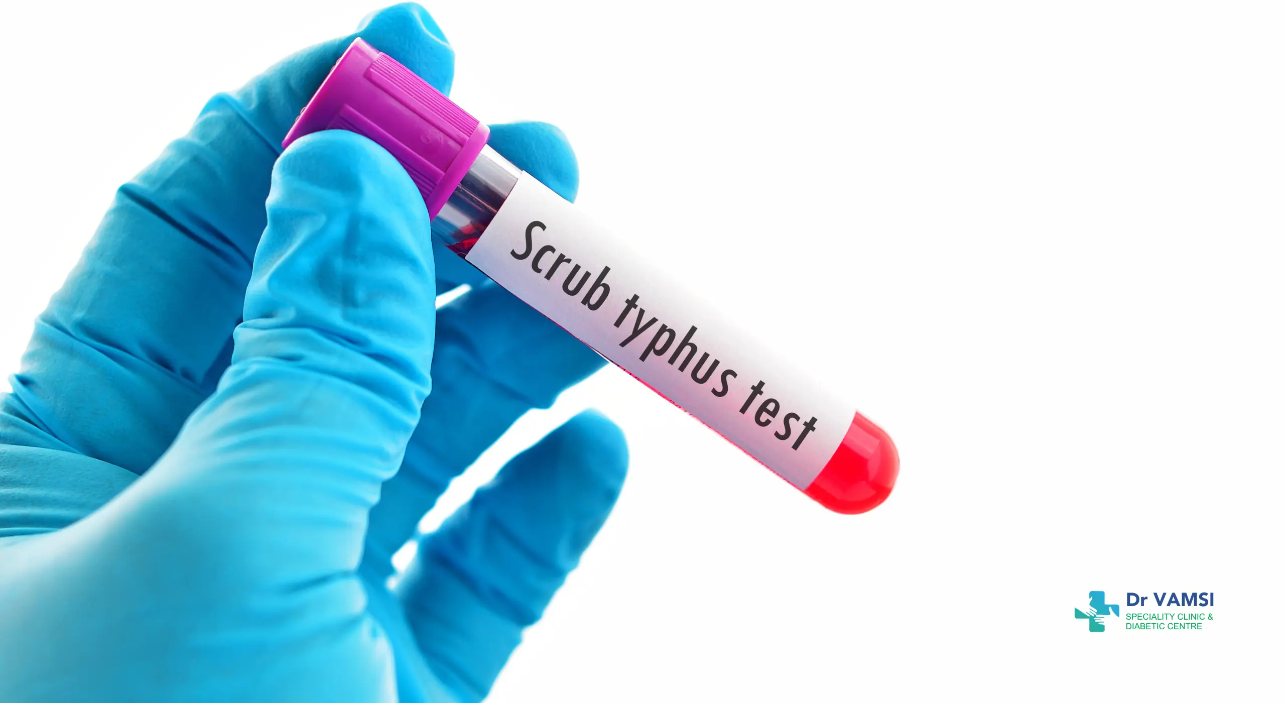 scrub typhus symptoms